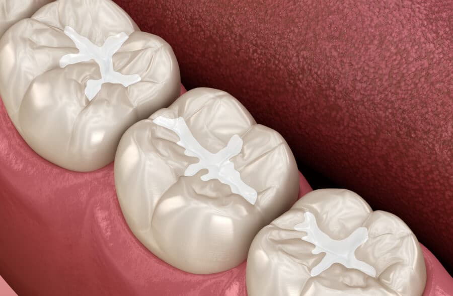 What Type of Dental Fillings Last the Longest?