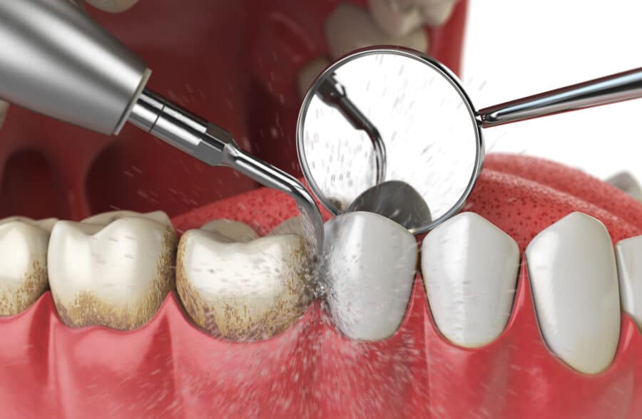 Conventional Teeth Cleaning