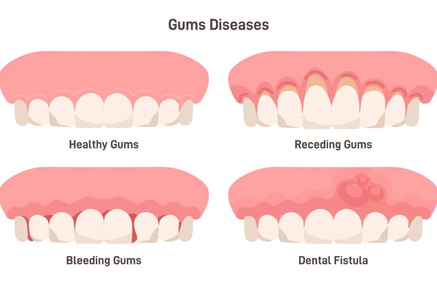 Receding Gums diseases