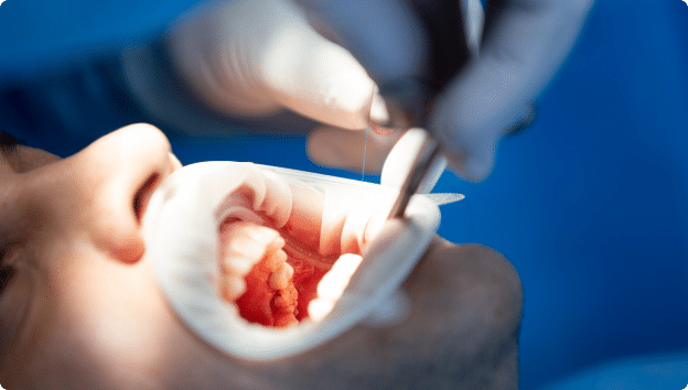 Dental Implants in Mississauga