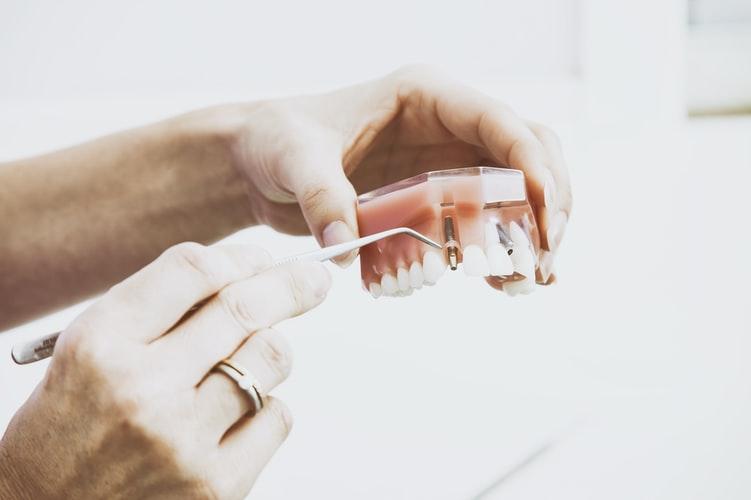How to Get Dental Implants in Mississauga
