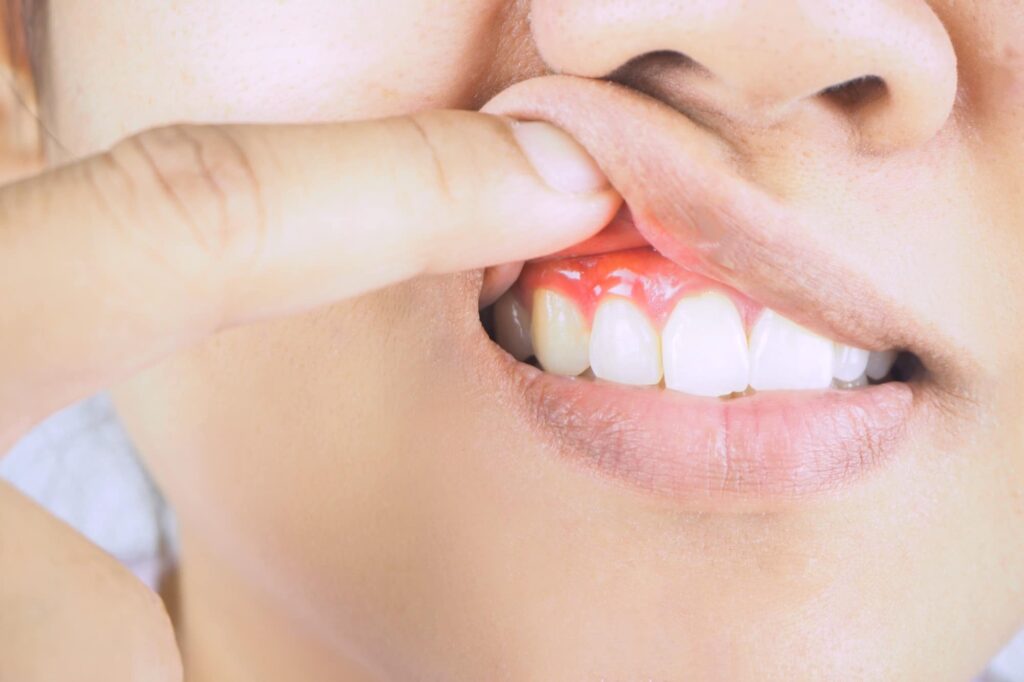 What Are Tips for Getting Rid of Gingivitis