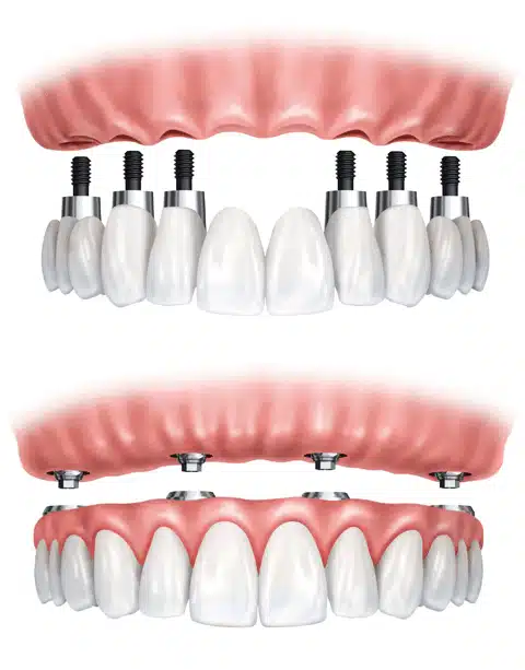 Implant-supported dentures Mississauga