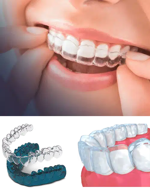 Invisalign Clear Braces Mississauga