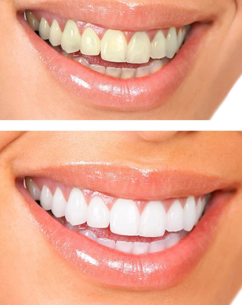 Teeth Whitening in Mississauga, ON